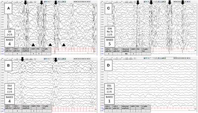 EEG biomarkers for the diagnosis and treatment of infantile spasms